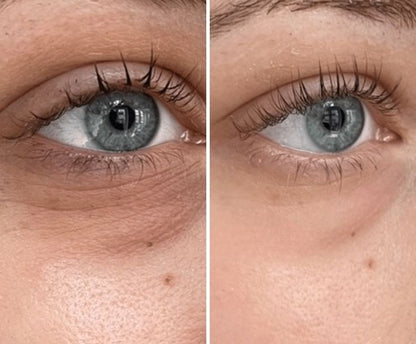 👁️ WAKE UP LOOKING YEARS YOUNGER Hyaluronic Acid Microneedle Eye Mask