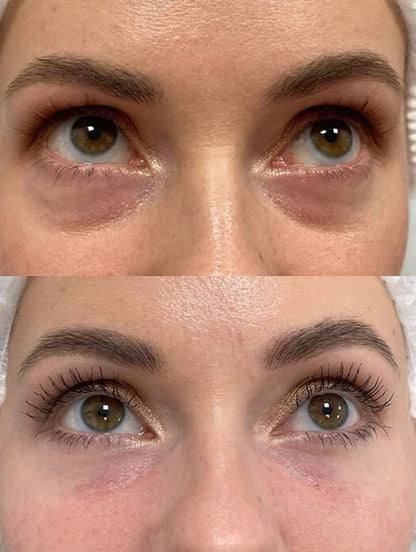 👁️ WAKE UP LOOKING YEARS YOUNGER Hyaluronic Acid Microneedle Eye Mask