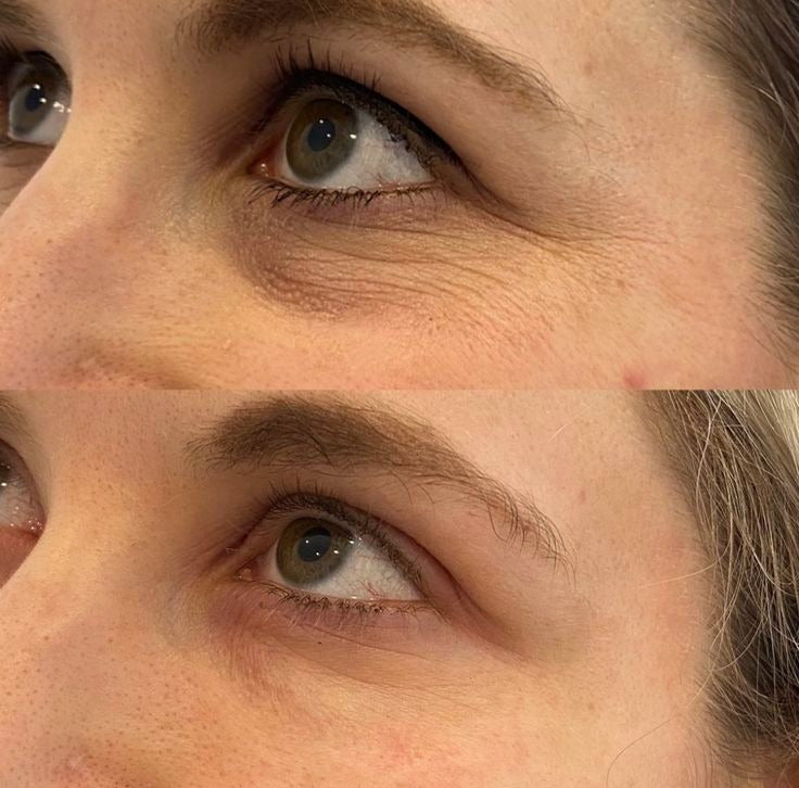 👁️ WAKE UP LOOKING YEARS YOUNGER Hyaluronic Acid Microneedle Eye Mask