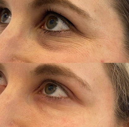 👁️ WAKE UP LOOKING YEARS YOUNGER Hyaluronic Acid Microneedle Eye Mask