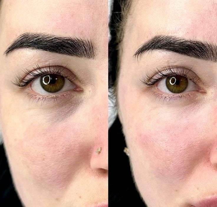 👁️ WAKE UP LOOKING YEARS YOUNGER Hyaluronic Acid Microneedle Eye Mask